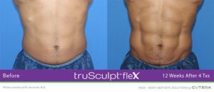 A model using our product Botox Cosmetic Treatment, Dermal Fillers, Double Chin Treatment, Skin Booster Treatment, Platelet-rich Plasma Injection, Thermage Treatment, Titan Skin Tightening Technology, Pearl Fractional Laser Treatment, Laser Genesis Treatment, Laser Toning Treatment, 3D Skin Rejuvenation Treatment, Intense Pulsed Light Therapy, Viora Radio Frequency Treatment, Blue Light Photodynamic Therapy, Laser Hair Removal, V-line Botox Treatment, Acne Scars Treatment, AviClear Laser Treatment, rosacea laser treatment, double chin removal, skin tightening treatment, Treatments for Uneven Skin Tone, Pigmentation Treatment, pore treatment, sweating botox treatment, Hair Loss Treatments, Non-Contact Fat Reduction, CoolSculpting, Redefining Muscle Sculpting, Ideal Protein Weight Loss Program, Microneedling Therapy, Microdermabrasion Therapy, and Chemical Peel by Trinity Medispa a Medical Cosmetic Clinic in Toronto located at 3434 Yonge St., Toronto, ON M4N 2M9.