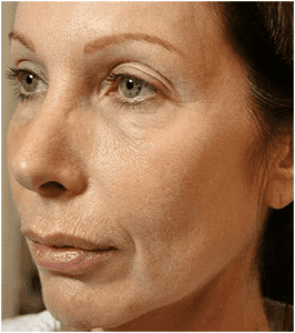 A model using our product Botox Cosmetic Treatment, Dermal Fillers, Double Chin Treatment, Skin Booster Treatment, Platelet-rich Plasma Injection, Thermage Treatment, Titan Skin Tightening Technology, Pearl Fractional Laser Treatment, Laser Genesis Treatment, Laser Toning Treatment, 3D Skin Rejuvenation Treatment, Intense Pulsed Light Therapy, Viora Radio Frequency Treatment, Blue Light Photodynamic Therapy, Laser Hair Removal, V-line Botox Treatment, Acne Scars Treatment, AviClear Laser Treatment, rosacea laser treatment, double chin removal, skin tightening treatment, Treatments for Uneven Skin Tone, Pigmentation Treatment, pore treatment, sweating botox treatment, Hair Loss Treatments, Non-Contact Fat Reduction, CoolSculpting, Redefining Muscle Sculpting, Ideal Protein Weight Loss Program, Microneedling Therapy, Microdermabrasion Therapy, and Chemical Peel by Trinity Medispa a Medical Cosmetic Clinic in Toronto located at 3434 Yonge St., Toronto, ON M4N 2M9.