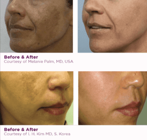 A model using our product Botox Cosmetic Treatment, Dermal Fillers, Double Chin Treatment, Skin Booster Treatment, Platelet-rich Plasma Injection, Thermage Treatment, Titan Skin Tightening Technology, Pearl Fractional Laser Treatment, Laser Genesis Treatment, Laser Toning Treatment, 3D Skin Rejuvenation Treatment, Intense Pulsed Light Therapy, Viora Radio Frequency Treatment, Blue Light Photodynamic Therapy, Laser Hair Removal, V-line Botox Treatment, Acne Scars Treatment, AviClear Laser Treatment, rosacea laser treatment, double chin removal, skin tightening treatment, Treatments for Uneven Skin Tone, Pigmentation Treatment, pore treatment, sweating botox treatment, Hair Loss Treatments, Non-Contact Fat Reduction, CoolSculpting, Redefining Muscle Sculpting, Ideal Protein Weight Loss Program, Microneedling Therapy, Microdermabrasion Therapy, and Chemical Peel by Trinity Medispa a Medical Cosmetic Clinic in Toronto located at 3434 Yonge St., Toronto, ON M4N 2M9.