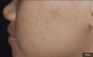 A model using our product Botox Cosmetic Treatment, Dermal Fillers, Double Chin Treatment, Skin Booster Treatment, Platelet-rich Plasma Injection, Thermage Treatment, Titan Skin Tightening Technology, Pearl Fractional Laser Treatment, Laser Genesis Treatment, Laser Toning Treatment, 3D Skin Rejuvenation Treatment, Intense Pulsed Light Therapy, Viora Radio Frequency Treatment, Blue Light Photodynamic Therapy, Laser Hair Removal, V-line Botox Treatment, Acne Scars Treatment, AviClear Laser Treatment, rosacea laser treatment, double chin removal, skin tightening treatment, Treatments for Uneven Skin Tone, Pigmentation Treatment, pore treatment, sweating botox treatment, Hair Loss Treatments, Non-Contact Fat Reduction, CoolSculpting, Redefining Muscle Sculpting, Ideal Protein Weight Loss Program, Microneedling Therapy, Microdermabrasion Therapy, and Chemical Peel by Trinity Medispa a Medical Cosmetic Clinic in Toronto located at 3434 Yonge St., Toronto, ON M4N 2M9.