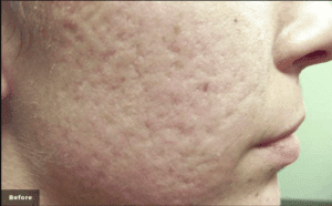 A model using our product Botox Cosmetic Treatment, Dermal Fillers, Double Chin Treatment, Skin Booster Treatment, Platelet-rich Plasma Injection, Thermage Treatment, Titan Skin Tightening Technology, Pearl Fractional Laser Treatment, Laser Genesis Treatment, Laser Toning Treatment, 3D Skin Rejuvenation Treatment, Intense Pulsed Light Therapy, Viora Radio Frequency Treatment, Blue Light Photodynamic Therapy, Laser Hair Removal, V-line Botox Treatment, Acne Scars Treatment, AviClear Laser Treatment, rosacea laser treatment, double chin removal, skin tightening treatment, Treatments for Uneven Skin Tone, Pigmentation Treatment, pore treatment, sweating botox treatment, Hair Loss Treatments, Non-Contact Fat Reduction, CoolSculpting, Redefining Muscle Sculpting, Ideal Protein Weight Loss Program, Microneedling Therapy, Microdermabrasion Therapy, and Chemical Peel by Trinity Medispa a Medical Cosmetic Clinic in Toronto located at 3434 Yonge St., Toronto, ON M4N 2M9.