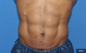 A model using our product Botox Cosmetic Treatment, Dermal Fillers, Double Chin Treatment, Skin Booster Treatment, Platelet-rich Plasma Injection, Thermage Treatment, Titan Skin Tightening Technology, Pearl Fractional Laser Treatment, Laser Genesis Treatment, Laser Toning Treatment, 3D Skin Rejuvenation Treatment, Intense Pulsed Light Therapy, Viora Radio Frequency Treatment, Blue Light Photodynamic Therapy, Laser Hair Removal, V-line Botox Treatment, Acne Scars Treatment, AviClear Laser Treatment, rosacea laser treatment, double chin removal, skin tightening treatment, Treatments for Uneven Skin Tone, Pigmentation Treatment, pore treatment, sweating botox treatment, Hair Loss Treatments, Non-Contact Fat Reduction, CoolSculpting, Redefining Muscle Sculpting, Ideal Protein Weight Loss Program, Microneedling Therapy, Microdermabrasion Therapy, and Chemical Peel by Trinity Medispa a Medical Cosmetic Clinic in Toronto located at 3434 Yonge St., Toronto, ON M4N 2M9.