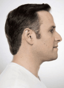 A model using our product Botox Cosmetic Treatment, Dermal Fillers, Double Chin Treatment, Skin Booster Treatment, Platelet-rich Plasma Injection, Thermage Treatment, Titan Skin Tightening Technology, Pearl Fractional Laser Treatment, Laser Genesis Treatment, Laser Toning Treatment, 3D Skin Rejuvenation Treatment, Intense Pulsed Light Therapy, Viora Radio Frequency Treatment, Blue Light Photodynamic Therapy, Laser Hair Removal, V-line Botox Treatment, Acne Scars Treatment, AviClear Laser Treatment, rosacea laser treatment, double chin removal, skin tightening treatment, Treatments for Uneven Skin Tone, Pigmentation Treatment, pore treatment, sweating botox treatment, Hair Loss Treatments, Non-Contact Fat Reduction, CoolSculpting, Redefining Muscle Sculpting, Ideal Protein Weight Loss Program, Microneedling Therapy, Microdermabrasion Therapy, and Chemical Peel by Trinity Medispa a Medical Cosmetic Clinic in Toronto located at 3434 Yonge St., Toronto, ON M4N 2M9.