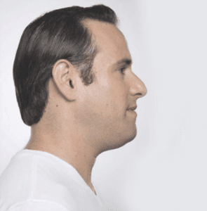 A model using our product Botox Cosmetic Treatment, Dermal Fillers, Double Chin Treatment, Skin Booster Treatment, Platelet-rich Plasma Injection, Thermage Treatment, Titan Skin Tightening Technology, Pearl Fractional Laser Treatment, Laser Genesis Treatment, Laser Toning Treatment, 3D Skin Rejuvenation Treatment, Intense Pulsed Light Therapy, Viora Radio Frequency Treatment, Blue Light Photodynamic Therapy, Laser Hair Removal, V-line Botox Treatment, Acne Scars Treatment, AviClear Laser Treatment, rosacea laser treatment, double chin removal, skin tightening treatment, Treatments for Uneven Skin Tone, Pigmentation Treatment, pore treatment, sweating botox treatment, Hair Loss Treatments, Non-Contact Fat Reduction, CoolSculpting, Redefining Muscle Sculpting, Ideal Protein Weight Loss Program, Microneedling Therapy, Microdermabrasion Therapy, and Chemical Peel by Trinity Medispa a Medical Cosmetic Clinic in Toronto located at 3434 Yonge St., Toronto, ON M4N 2M9.