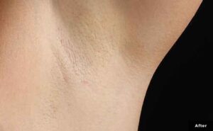 A model using our product Botox Cosmetic Treatment, Dermal Fillers, Double Chin Treatment, Skin Booster Treatment, Platelet-rich Plasma Injection, Thermage Treatment, Titan Skin Tightening Technology, Pearl Fractional Laser Treatment, Laser Genesis Treatment, Laser Toning Treatment, 3D Skin Rejuvenation Treatment, Intense Pulsed Light Therapy, Viora Radio Frequency Treatment, Blue Light Photodynamic Therapy, Laser Hair Removal, V-line Botox Treatment, Acne Scars Treatment, AviClear Laser Treatment, rosacea laser treatment, double chin removal, skin tightening treatment, Treatments for Uneven Skin Tone, Pigmentation Treatment, pore treatment, sweating botox treatment, Hair Loss Treatments, Non-Contact Fat Reduction, CoolSculpting, Redefining Muscle Sculpting, Ideal Protein Weight Loss Program, Microneedling Therapy, Microdermabrasion Therapy, and Chemical Peel by Trinity Medispa a Medical Cosmetic Clinic in Toronto located at 3434 Yonge St., Toronto, ON M4N 2M9.