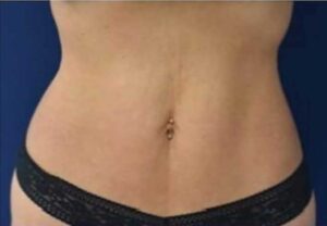 A model using our product Botox Cosmetic Treatment, Dermal Fillers, Double Chin Treatment, Skin Booster Treatment, Platelet-rich Plasma Injection, Thermage Treatment, Titan Skin Tightening Technology, Pearl Fractional Laser Treatment, Laser Genesis Treatment, Laser Toning Treatment, 3D Skin Rejuvenation Treatment, Intense Pulsed Light Therapy, Viora Radio Frequency Treatment, Blue Light Photodynamic Therapy, Laser Hair Removal, V-line Botox Treatment, Acne Scars Treatment, AviClear Laser Treatment, rosacea laser treatment, double chin removal, skin tightening treatment, Treatments for Uneven Skin Tone, Pigmentation Treatment, pore treatment, sweating botox treatment, Hair Loss Treatments, Non-Contact Fat Reduction, CoolSculpting, Redefining Muscle Sculpting, Ideal Protein Weight Loss Program, Microneedling Therapy, Microdermabrasion Therapy, and Chemical Peel by Trinity Medispa a Medical Cosmetic Clinic in Toronto located at 3434 Yonge St., Toronto, ON M4N 2M9.