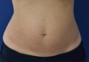 A model using our product Botox Cosmetic Treatment, Dermal Fillers, Double Chin Treatment, Skin Booster Treatment, Platelet-rich Plasma Injection, Thermage Treatment, Titan Skin Tightening Technology, Pearl Fractional Laser Treatment, Laser Genesis Treatment, Laser Toning Treatment, 3D Skin Rejuvenation Treatment, Intense Pulsed Light Therapy, Viora Radio Frequency Treatment, Blue Light Photodynamic Therapy, Laser Hair Removal, V-line Botox Treatment, Acne Scars Treatment, AviClear Laser Treatment, rosacea laser treatment, double chin removal, skin tightening treatment, Treatments for Uneven Skin Tone, Pigmentation Treatment, pore treatment, sweating botox treatment, Hair Loss Treatments, Non-Contact Fat Reduction, CoolSculpting, Redefining Muscle Sculpting, Ideal Protein Weight Loss Program, Microneedling Therapy, Microdermabrasion Therapy, and Chemical Peel by Trinity Medispa a Medical Cosmetic Clinic in Toronto located at 3434 Yonge St., Toronto, ON M4N 2M9.