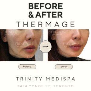 A model using our product Botox Cosmetic Treatment, Dermal Fillers, Double Chin Treatment, Skin Booster Treatment, Platelet-rich Plasma Injection, Thermage Treatment, Titan Skin Tightening Technology, Pearl Fractional Laser Treatment, Laser Genesis Treatment, Laser Toning Treatment, 3D Skin Rejuvenation Treatment, Intense Pulsed Light Therapy, Viora Radio Frequency Treatment, Blue Light Photodynamic Therapy, Laser Hair Removal, V-line Botox Treatment, Acne Scars Treatment, AviClear Laser Treatment, rosacea laser treatment, double chin removal, skin tightening treatment, Treatments for Uneven Skin Tone, Pigmentation Treatment, pore treatment, sweating botox treatment, Hair Loss Treatments, Non-Contact Fat Reduction, CoolSculpting, Redefining Muscle Sculpting, Ideal Protein Weight Loss Program, Microneedling Therapy, Microdermabrasion Therapy, and Chemical Peel by Trinity Medispa a Medical Cosmetic Clinic in Toronto located at 3434 Yonge St., Toronto, ON M4N 2M9.