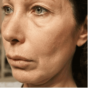 A model using our product Botox Cosmetic Treatment, Dermal Fillers, Double Chin Treatment, Skin Booster Treatment, Platelet-rich Plasma Injection, Thermage Treatment, Titan Skin Tightening Technology, Pearl Fractional Laser Treatment, Laser Genesis Treatment, Laser Toning Treatment, 3D Skin Rejuvenation Treatment, Intense Pulsed Light Therapy, Viora Radio Frequency Treatment, Blue Light Photodynamic Therapy, Laser Hair Removal, V-line Botox Treatment, Acne Scars Treatment, AviClear Laser Treatment, rosacea laser treatment, double chin removal, skin tightening treatment, Treatments for Uneven Skin Tone, Pigmentation Treatment, pore treatment, sweating botox treatment, Hair Loss Treatments, Non-Contact Fat Reduction, CoolSculpting, Redefining Muscle Sculpting, Ideal Protein Weight Loss Program, Microneedling Therapy, Microdermabrasion Therapy, and Chemical Peel by Trinity Medispa a Medical Cosmetic Clinic in Toronto located at 3434 Yonge St., Toronto, ON M4N 2M9.