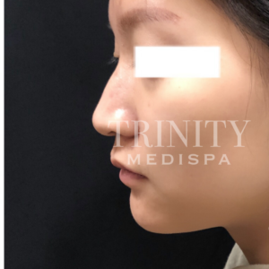 A model using our product Botox Cosmetic Treatment, Dermal Fillers, Double Chin Treatment, Skin Booster Treatment, Platelet-rich Plasma Injection, Thermage Treatment, Titan Skin Tightening Technology, Pearl Fractional Laser Treatment, Laser Genesis Treatment, Laser Toning Treatment, 3D Skin Rejuvenation Treatment, Intense Pulsed Light Therapy, Viora Radio Frequency Treatment, Blue Light Photodynamic Therapy, Laser Hair Removal, V-line Botox Treatment, Acne Scars Treatment, AviClear Laser Treatment, rosacea laser treatment, double chin removal, skin tightening treatment, Treatments for Uneven Skin Tone, Pigmentation Treatment, pore treatment, sweating botox treatment, Hair Loss Treatments, Non-Contact Fat Reduction, CoolSculpting, Redefining Muscle Sculpting, Ideal Protein Weight Loss Program, Microneedling Therapy, Microdermabrasion Therapy, and Chemical Peel by Trinity Medispa a Medical Cosmetic Clinic in Toronto located at 3434 Yonge St., Toronto, ON M4N 2M9.