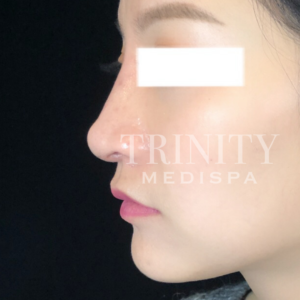 A model using our product Botox Cosmetic Treatment, Dermal Fillers, Double Chin Treatment, Skin Booster Treatment, Platelet-rich Plasma Injection, Thermage Treatment, Titan Skin Tightening Technology, Pearl Fractional Laser Treatment, Laser Genesis Treatment, Laser Toning Treatment, 3D Skin Rejuvenation Treatment, Intense Pulsed Light Therapy, Viora Radio Frequency Treatment, Blue Light Photodynamic Therapy, Laser Hair Removal, V-line Botox Treatment, Acne Scars Treatment, AviClear Laser Treatment, rosacea laser treatment, double chin removal, skin tightening treatment, Treatments for Uneven Skin Tone, Pigmentation Treatment, pore treatment, sweating botox treatment, Hair Loss Treatments, Non-Contact Fat Reduction, CoolSculpting, Redefining Muscle Sculpting, Ideal Protein Weight Loss Program, Microneedling Therapy, Microdermabrasion Therapy, and Chemical Peel by Trinity Medispa a Medical Cosmetic Clinic in Toronto located at 3434 Yonge St., Toronto, ON M4N 2M9.