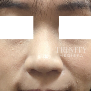 A model using our product Botox Cosmetic Treatment, Dermal Fillers, Double Chin Treatment, Skin Booster Treatment, Platelet-rich Plasma Injection, Thermage Treatment, Titan Skin Tightening Technology, Pearl Fractional Laser Treatment, Laser Genesis Treatment, Laser Toning Treatment, 3D Skin Rejuvenation Treatment, Intense Pulsed Light Therapy, Viora Radio Frequency Treatment, Blue Light Photodynamic Therapy, Laser Hair Removal, V-line Botox Treatment, Acne Scars Treatment, AviClear Laser Treatment, rosacea laser treatment, double chin removal, skin tightening treatment, Treatments for Uneven Skin Tone, Pigmentation Treatment, pore treatment, sweating botox treatment, Hair Loss Treatments, Non-Contact Fat Reduction, CoolSculpting, Redefining Muscle Sculpting, Ideal Protein Weight Loss Program, Microneedling Therapy, Microdermabrasion Therapy, and Chemical Peel by Trinity Medispa a Medical Cosmetic Clinic in Toronto located at 3434 Yonge St., Toronto, ON M4N 2M9.