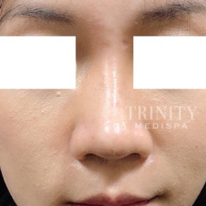 A model using our product Botox Cosmetic Treatment, Dermal Fillers, Double Chin Treatment, Skin Booster Treatment, Platelet-rich Plasma Injection, Thermage Treatment, Titan Skin Tightening Technology, Pearl Fractional Laser Treatment, Laser Genesis Treatment, Laser Toning Treatment, 3D Skin Rejuvenation Treatment, Intense Pulsed Light Therapy, Viora Radio Frequency Treatment, Blue Light Photodynamic Therapy, Laser Hair Removal, V-line Botox Treatment, Acne Scars Treatment, AviClear Laser Treatment, rosacea laser treatment, double chin removal, skin tightening treatment, Treatments for Uneven Skin Tone, Pigmentation Treatment, pore treatment, sweating botox treatment, Hair Loss Treatments, Non-Contact Fat Reduction, CoolSculpting, Redefining Muscle Sculpting, Ideal Protein Weight Loss Program, Microneedling Therapy, Microdermabrasion Therapy, and Chemical Peel by Trinity Medispa a Medical Cosmetic Clinic in Toronto located at 3434 Yonge St., Toronto, ON M4N 2M9.