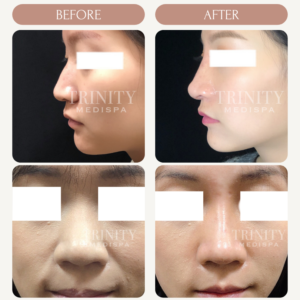 A model using our product Botox Cosmetic Treatment, Dermal Fillers, Double Chin Treatment, Skin Booster Treatment, Platelet-rich Plasma Injection, Thermage Treatment, Titan Skin Tightening Technology, Pearl Fractional Laser Treatment, Laser Genesis Treatment, Laser Toning Treatment, 3D Skin Rejuvenation Treatment, Intense Pulsed Light Therapy, Viora Radio Frequency Treatment, Blue Light Photodynamic Therapy, Laser Hair Removal, V-line Botox Treatment, Acne Scars Treatment, AviClear Laser Treatment, rosacea laser treatment, double chin removal, skin tightening treatment, Treatments for Uneven Skin Tone, Pigmentation Treatment, pore treatment, sweating botox treatment, Hair Loss Treatments, Non-Contact Fat Reduction, CoolSculpting, Redefining Muscle Sculpting, Ideal Protein Weight Loss Program, Microneedling Therapy, Microdermabrasion Therapy, and Chemical Peel by Trinity Medispa a Medical Cosmetic Clinic in Toronto located at 3434 Yonge St., Toronto, ON M4N 2M9.