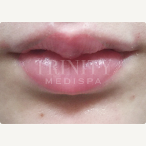 A model using our product Botox Cosmetic Treatment, Dermal Fillers, Double Chin Treatment, Skin Booster Treatment, Platelet-rich Plasma Injection, Thermage Treatment, Titan Skin Tightening Technology, Pearl Fractional Laser Treatment, Laser Genesis Treatment, Laser Toning Treatment, 3D Skin Rejuvenation Treatment, Intense Pulsed Light Therapy, Viora Radio Frequency Treatment, Blue Light Photodynamic Therapy, Laser Hair Removal, V-line Botox Treatment, Acne Scars Treatment, AviClear Laser Treatment, rosacea laser treatment, double chin removal, skin tightening treatment, Treatments for Uneven Skin Tone, Pigmentation Treatment, pore treatment, sweating botox treatment, Hair Loss Treatments, Non-Contact Fat Reduction, CoolSculpting, Redefining Muscle Sculpting, Ideal Protein Weight Loss Program, Microneedling Therapy, Microdermabrasion Therapy, and Chemical Peel by Trinity Medispa a Medical Cosmetic Clinic in Toronto located at 3434 Yonge St., Toronto, ON M4N 2M9.