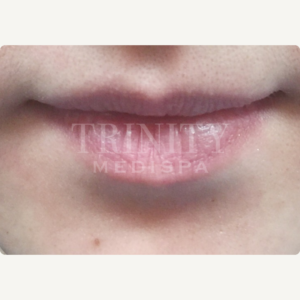 A model using our product Botox Cosmetic Treatment, Dermal Fillers, Double Chin Treatment, Skin Booster Treatment, Platelet-rich Plasma Injection, Thermage Treatment, Titan Skin Tightening Technology, Pearl Fractional Laser Treatment, Laser Genesis Treatment, Laser Toning Treatment, 3D Skin Rejuvenation Treatment, Intense Pulsed Light Therapy, Viora Radio Frequency Treatment, Blue Light Photodynamic Therapy, Laser Hair Removal, V-line Botox Treatment, Acne Scars Treatment, AviClear Laser Treatment, rosacea laser treatment, double chin removal, skin tightening treatment, Treatments for Uneven Skin Tone, Pigmentation Treatment, pore treatment, sweating botox treatment, Hair Loss Treatments, Non-Contact Fat Reduction, CoolSculpting, Redefining Muscle Sculpting, Ideal Protein Weight Loss Program, Microneedling Therapy, Microdermabrasion Therapy, and Chemical Peel by Trinity Medispa a Medical Cosmetic Clinic in Toronto located at 3434 Yonge St., Toronto, ON M4N 2M9.