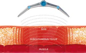 Illustration of BTL Vanquish treatment layers showing skin, subcutaneous tissue, and muscle with device emitting waves for body sculpting and anti-aging solutions.