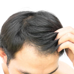 A model using our product Botox Cosmetic Treatment, Dermal Fillers, Double Chin Treatment, Skin Booster Treatment, Platelet-rich Plasma Injection, Thermage Treatment, Titan Skin Tightening Technology, Pearl Fractional Laser Treatment, Laser Genesis Treatment, Laser Toning Treatment, 3D Skin Rejuvenation Treatment, Intense Pulsed Light Therapy, Viora Radio Frequency Treatment, Blue Light Photodynamic Therapy, Laser Hair Removal, V-line Botox Treatment, Acne Scars Treatment, AviClear Laser Treatment, rosacea laser treatment, double chin removal, skin tightening treatment, Treatments for Uneven Skin Tone, Pigmentation Treatment, pore treatment, sweating botox treatment, Hair Loss Treatments, Non-Contact Fat Reduction, CoolSculpting, Redefining Muscle Sculpting, Ideal Protein Weight Loss Program, Microneedling Therapy, Microdermabrasion Therapy, and Chemical Peel by Trinity Medispa a Medical Cosmetic Clinic in Toronto located at 3434 Yonge St., Toronto, ON M4N 2M9.